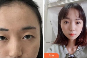 內(nèi)江市中醫(yī)醫(yī)院百合醫(yī)學(xué)美容中心李相君整形價(jià)格表附切開(kāi)雙眼皮案例展示