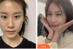 內(nèi)江百齡京菊醫(yī)療美容門(mén)診部文斌整形價(jià)格表附切開(kāi)雙眼皮案例展示