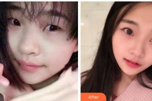 內(nèi)江百齡京菊醫(yī)療美容門(mén)診部謝肇菊整形價(jià)格表附切開(kāi)雙眼皮案例展示