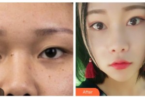 內(nèi)江瑞美醫(yī)療美容門(mén)診部羅冬鈴整形價(jià)格表附切開(kāi)雙眼皮案例展示