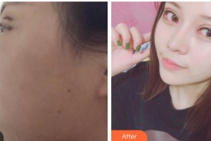 內(nèi)江瑞美醫(yī)療美容門(mén)診部金承俊整形價(jià)格表附眼部綜合案例展示