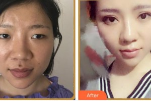 內(nèi)江洋子醫(yī)療美容診所羊一華整形價(jià)格表附眼部綜合案例展示