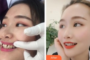 內(nèi)江華美口腔醫(yī)院代季佩整形價(jià)格表附隱形托槽矯正案例展示