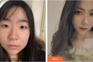 樂(lè)山天姿醫(yī)療美容診所楊劍軍整形價(jià)格表附埋線雙眼皮案例展示