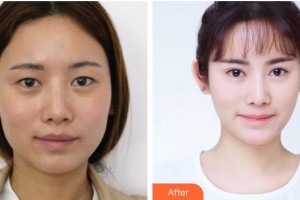 樂(lè)山市人民醫(yī)院燒傷整形外科賴(lài)運(yùn)泰整形價(jià)格表附眼部綜合案例展示