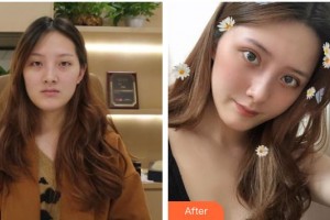 樂(lè)山美銳整形美容診所魏海軍整形價(jià)格表附切開(kāi)雙眼皮案例展示