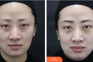 樂(lè)山王玉琨皮膚病專(zhuān)科醫(yī)院王玉琨整形價(jià)格表附激光去眼袋案例展示