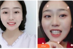 樂(lè)山口腔醫(yī)院汪培林整形價(jià)格表附牙齒隱形矯正案例展示