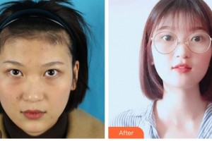 樂(lè)山愛(ài)爾眼科醫(yī)院張繼萍整形價(jià)格表附內(nèi)切祛眼袋案例展示