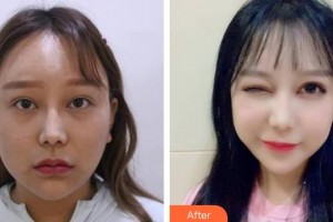 樂(lè)山愛(ài)爾眼科醫(yī)院帥彤整形價(jià)格表附眼部綜合案例展示