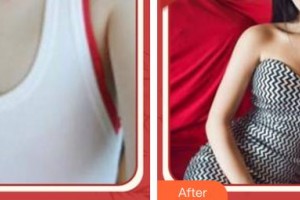 南充醫(yī)美整形外科診所劉乃軍整形價(jià)格表附自體脂肪隆胸案例展示