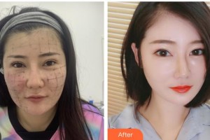 南充新韻悅美醫(yī)療美容門診部杜娟杜娟整形價(jià)格表附熱瑪吉案例展示