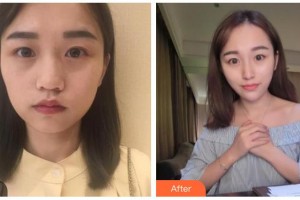 南充中心醫(yī)院整形美容外科李凌云整形價(jià)格表附熱瑪吉案例展示