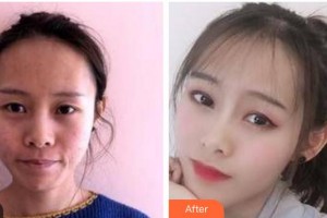 南充陳氏藍天醫(yī)院醫(yī)學整形美容中心陳代義整形價格表附埋線提升案例展示