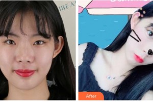 南充中心醫(yī)院整形美容外科田超整形價格表附熱瑪吉案例展示