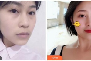 南充中心醫(yī)院整形美容外科徐海整形價格表附埋線提升案例展示