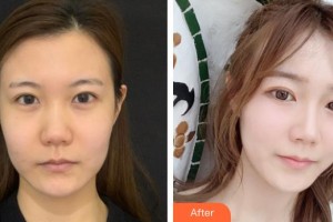 南充中心醫(yī)院整形美容外科肖文明整形價格表附熱瑪吉案例展示