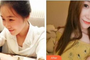 南充中心醫(yī)院整形美容外科張?zhí)m芳整形價格表附熱瑪吉案例展示