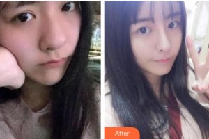 南充中心醫(yī)院整形美容外科蔣欣住院醫(yī)師整形價格表附熱瑪吉案例展示