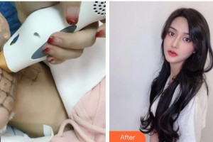 南充中心醫(yī)院整形美容外科高華偉住院醫(yī)師整形價格表附熱瑪吉案例展示