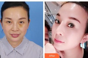 南充中心醫(yī)院整形美容外科劉鴻雁住院醫(yī)師整形價格表附埋線提升案例展示