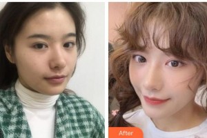 南充嘉陵江醫(yī)療美容診所彭海濤整形價格表附熱瑪吉案例展示