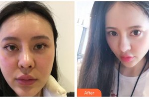 南充阿藍醫(yī)療美容門診部傅崇華整形價格表附埋線提升案例展示