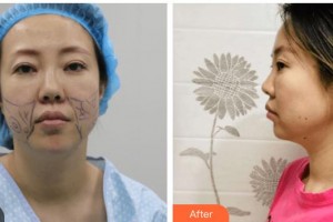 南充阿藍(lán)醫(yī)療美容門診部李仁華整形價(jià)格表附埋線提升案例展示