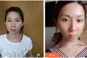 南充阿藍(lán)醫(yī)療美容門診部常明整形價(jià)格表附熱拉提案例展示