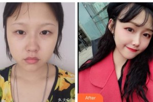 南充阿藍(lán)醫(yī)療美容門診部賀怡整形價(jià)格表附埋線提升案例展示