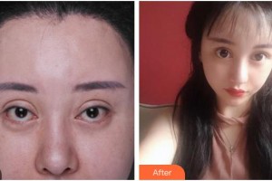 南充嬌美傾城醫(yī)學(xué)美容門診部劉娟整形價(jià)格表附眼部修復(fù)案例展示