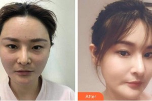 南充新韻悅美醫(yī)療美容門診部鄧志文整形價(jià)格表附埋線提升案例展示