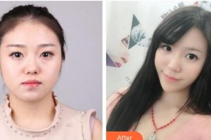 南充韓美整形美容門診部龔承安整形價(jià)格表附埋線提升案例展示