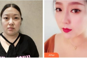 南充新韻悅美醫(yī)療美容門診部何秀整形價(jià)格表附埋線提升案例展示