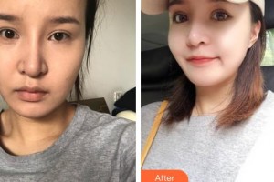 南充五星美容整形門診部劉漢儒整形價(jià)格表附埋線提升案例展示