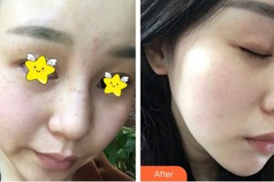 南充五星美容整形門診部楊建國(guó)整形價(jià)格表附激光美膚激光案例展示