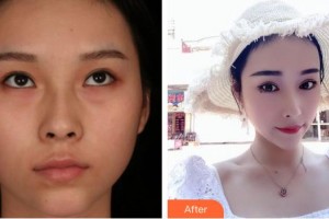 南充五星美容整形門診部劉新一整形價格表附切開雙眼皮案例展示