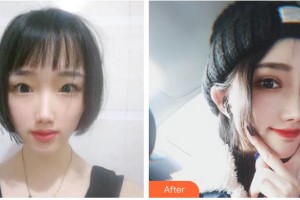 南充五星美容整形門診部唐雨珍整形價格表附切開雙眼皮案例展示