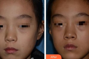 南充韓美整形美容門診部鄧麗華整形價格表附激光點痣案例展示