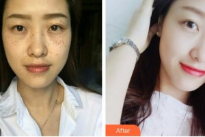 南充嬌美傾城醫(yī)學美容門診部劉曉春整形價格表附鐳射凈膚案例展示