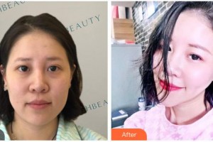 南充嬌美傾城醫(yī)學美容門診部曾飛整形價格表附熱瑪吉案例展示