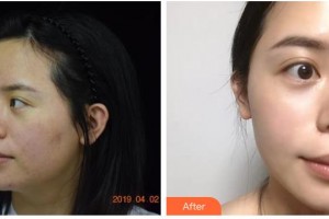 南充醫(yī)美整形外科診所李莎整形價格表附射頻緊膚案例展示