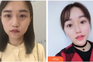 南充阿藍醫(yī)療美容門診部整形價格表附熱瑪吉案例展示