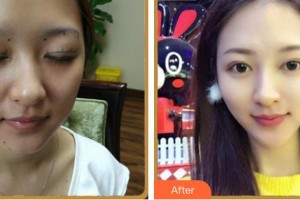 南充醫(yī)美爾美容整形診所劉明剛整形價格表附眼部綜合案例展示