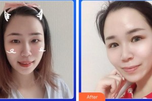 南充友豪醫(yī)院眼科李韋兵整形價格表附眼部綜合案例展示