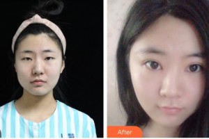 南充圣仁安名仁眼科醫(yī)院廖瓊整形價格表附切開雙眼皮案例展示
