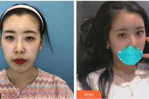 南充愛爾麥格眼科醫(yī)院冉海軍整形價格表附眼部綜合案例展示