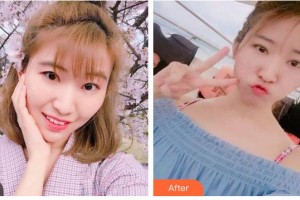 南充潤禾皮膚病專科醫(yī)院趙成均住院醫(yī)師整形價格表附切開雙眼皮案例展示