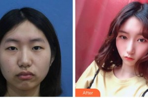 南充潤禾皮膚病專科醫(yī)院萬年整形價格表附上瞼提肌案例展示