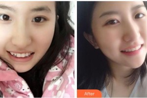 南充華醫(yī)口腔醫(yī)院楊建整形價格表附牙齒隱形矯正案例展示